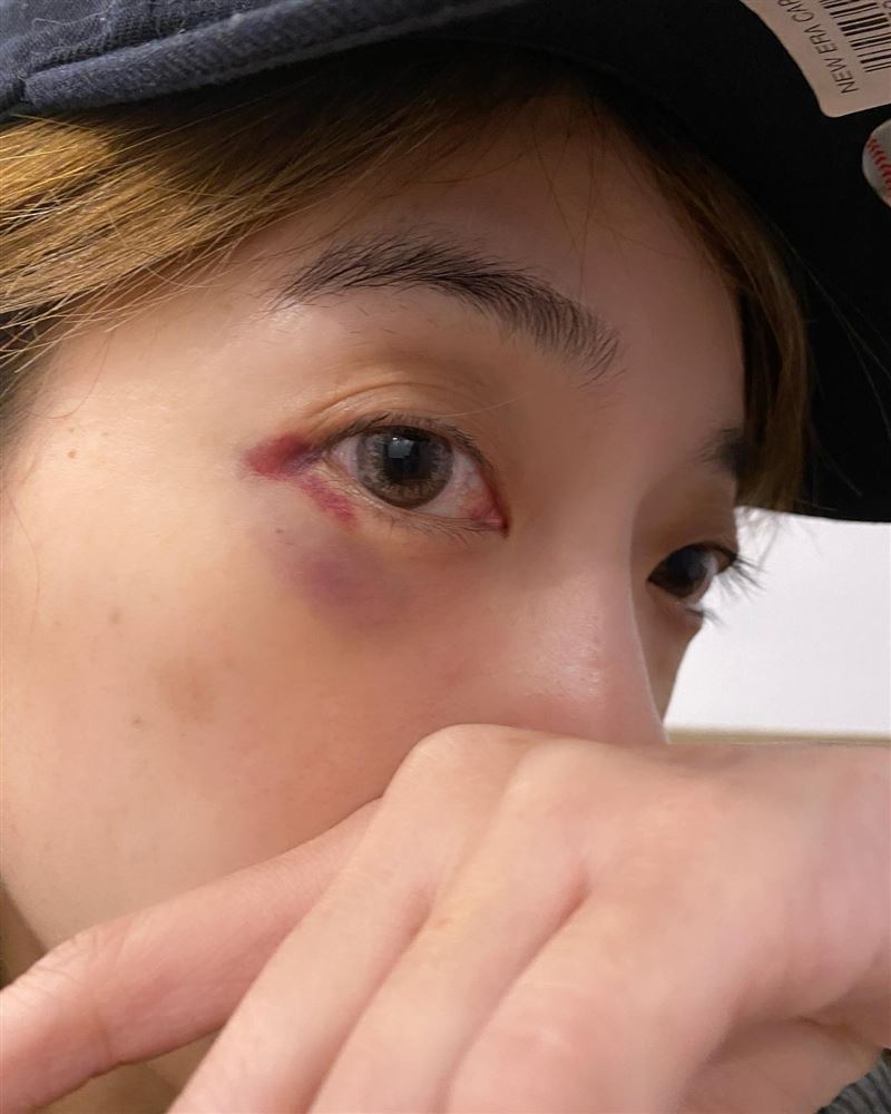 貝童彤臉蛋受傷眼睛明顯紅腫、瘀青,看起來傷勢不輕。(圖/翻攝自貝童彤臉書)