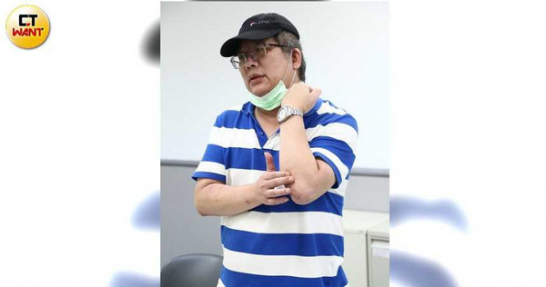 徐豪雄的免疫系統近日發生嚴重問題,其身上還出現過去不曾有的乾癬皮膚病。(圖/黃鵬杰攝)